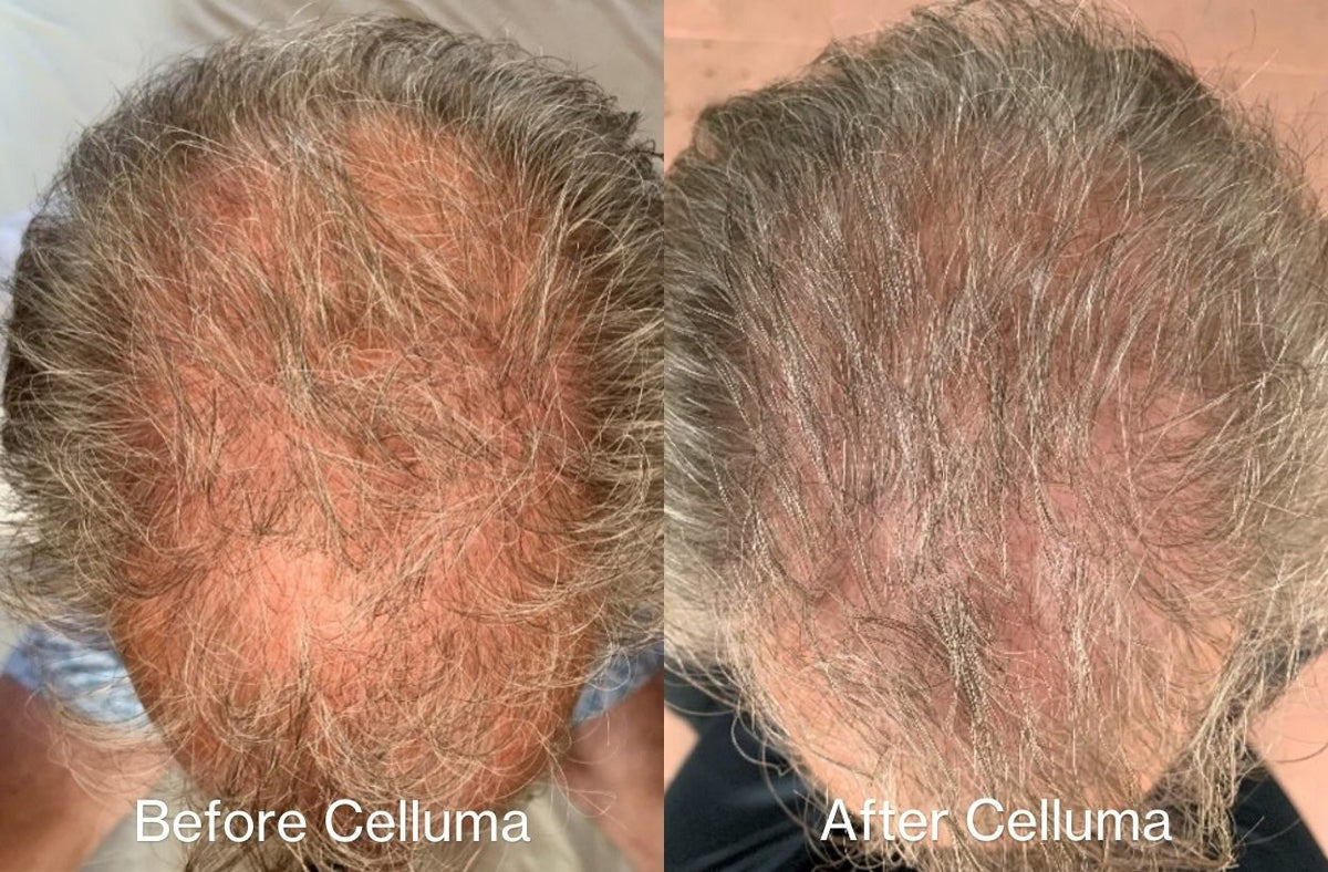 A side-by-side before-and-after comparison of a person's scalp, showing hair loss density reduction. The left side is labeled 'Before Celluma' and shows thinning hair with exposed scalp.